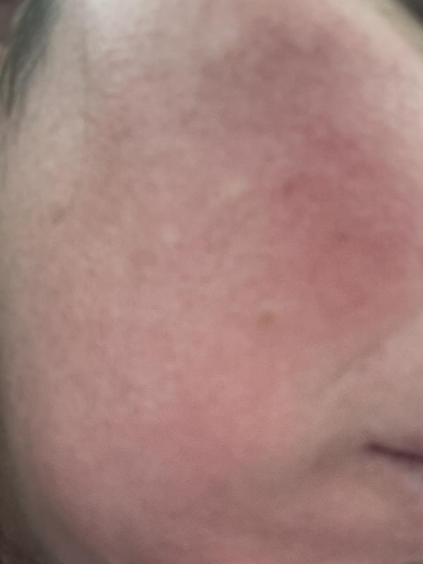 Redness is fading