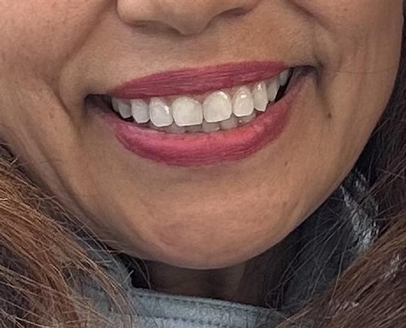 No Extra Whitening Necessary