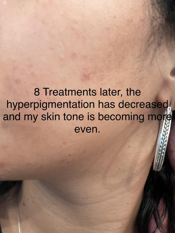 1st treatment compared to 8th treatment.