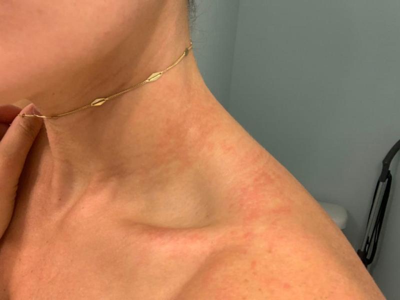 Customer photo for "BEWARE - ALLERGIC REACTION"
