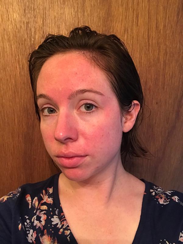 Redness after directed use