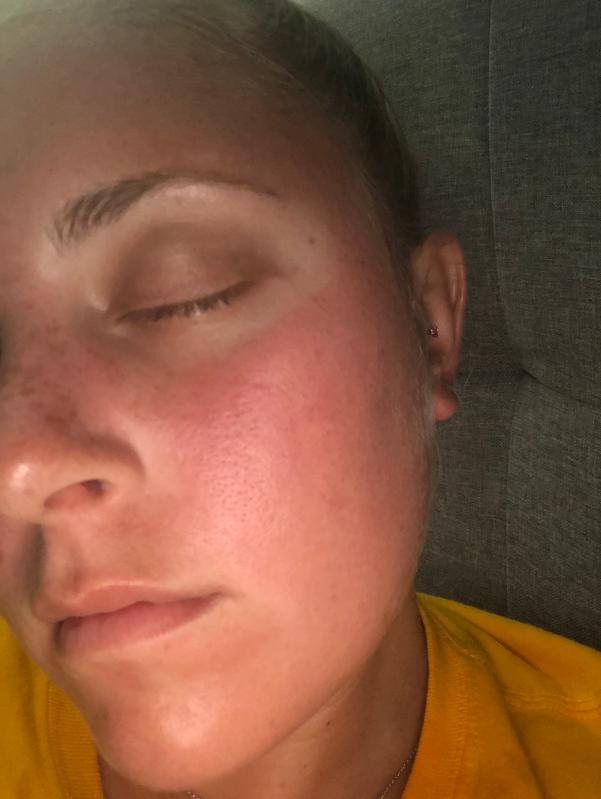 Redness only where the mask was :(