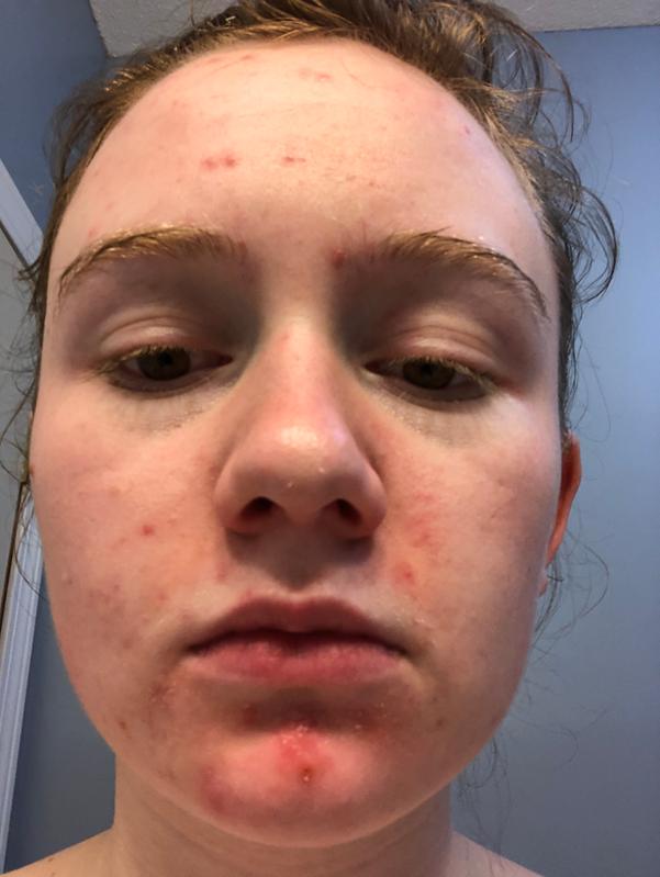 This was taken right after I washed my face, my bare skin