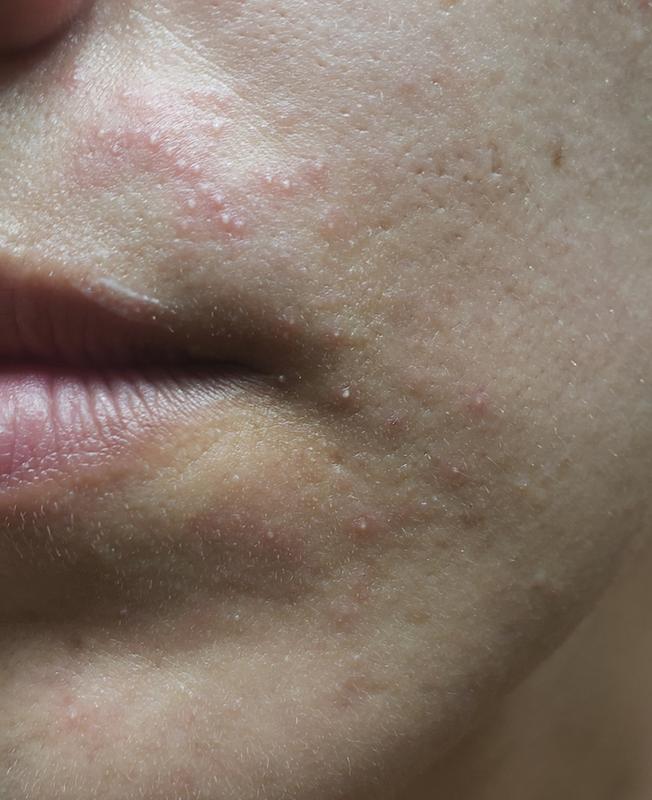 Burt's Bees Dark Spot Corrector – Gegen Dunkle Flecken, Für Alle Hauttypen, 30 Ml