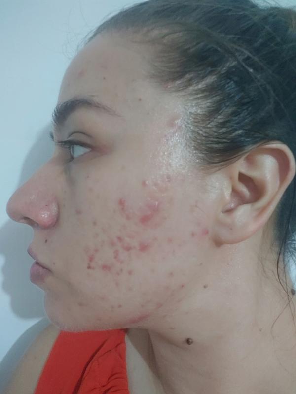 This is before I started using the face cream