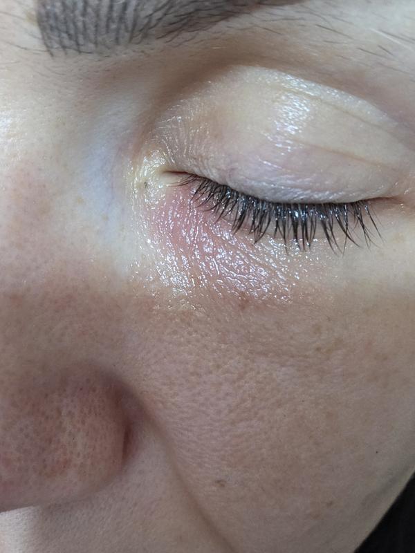Under eye red rash due use of micellar water sensitive skin