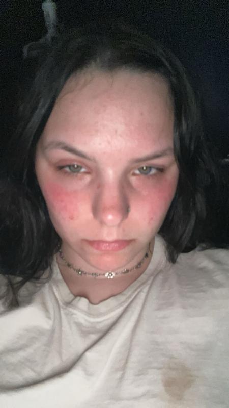 Burnt my cheeks!!