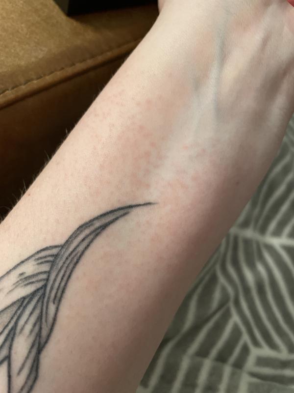 Left forearm, that’s just a small picture of my hives