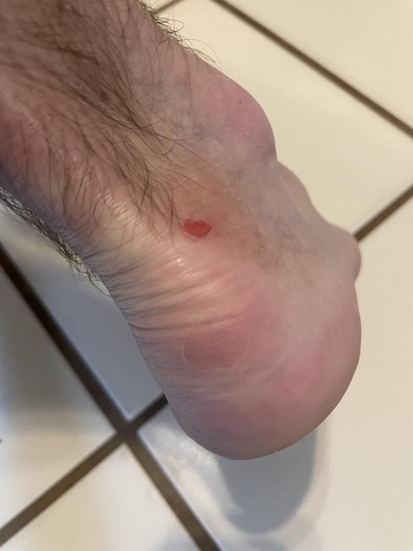 You can see the heel tear directly on the center heel, that took over a week to heal.