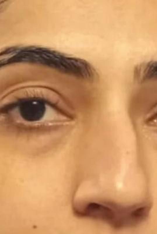 Customer photo for "Reduced bags under the eye."