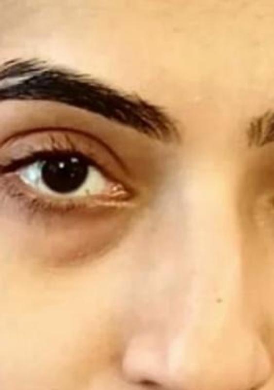 Customer photo for "Reduced bags under the eye."