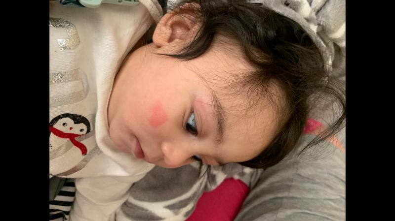 The Owl rattle hit him right above his eye. This was the next morning.