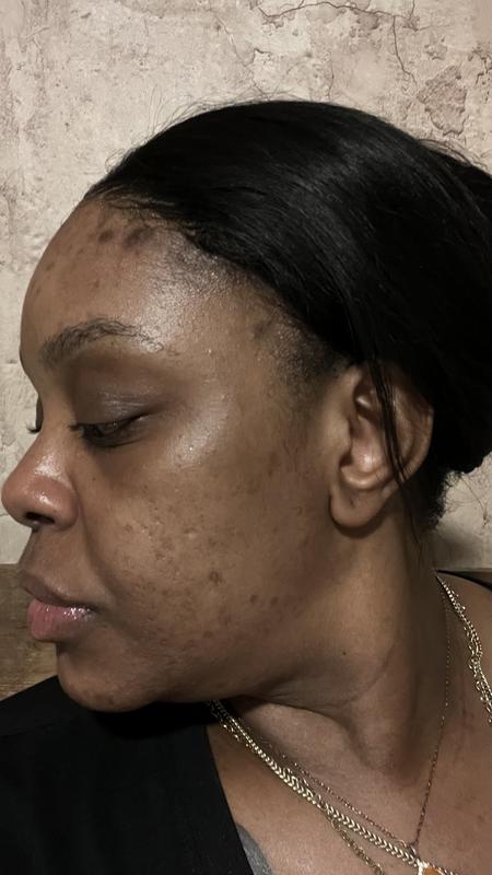 The Acne Set: Salicylic Acid 2% Regimen for Clear Skin