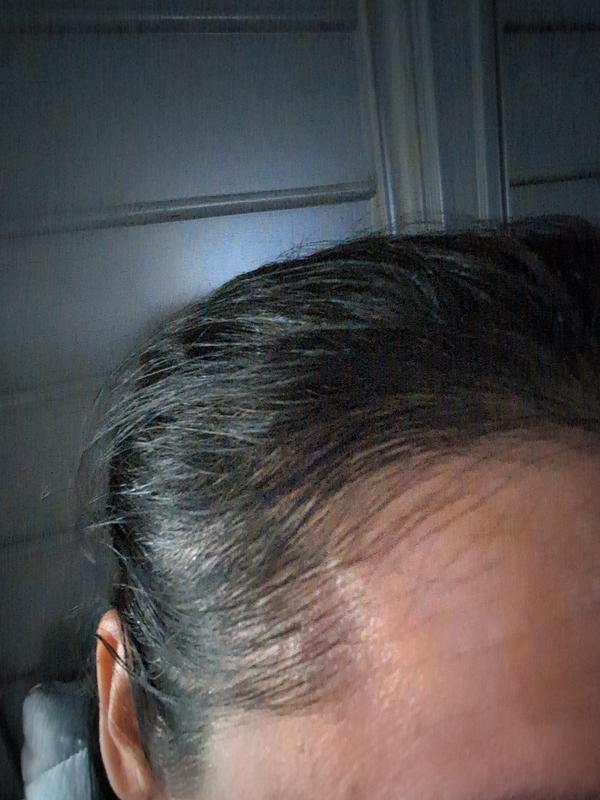 Customer photo for "Massive hair loss and thinning caused by the serum"