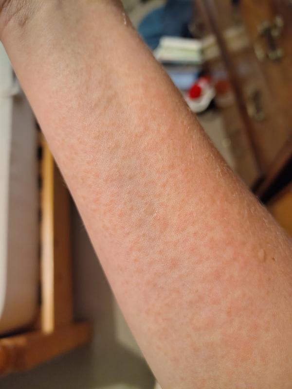 Customer photo for "Brought me out in a rash"
