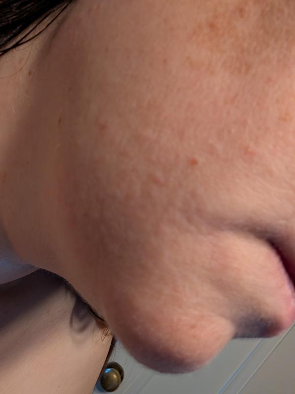 Customer photo for "Bumpy skin after using twice"