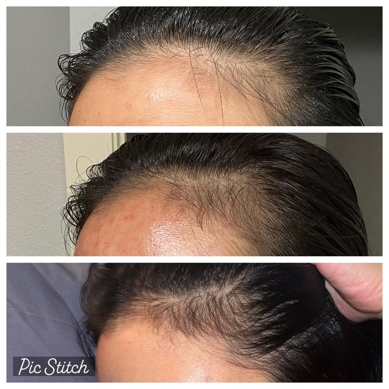 The Ordinary Hair Serum 1 Month Review + Before & Afters with Pictures 