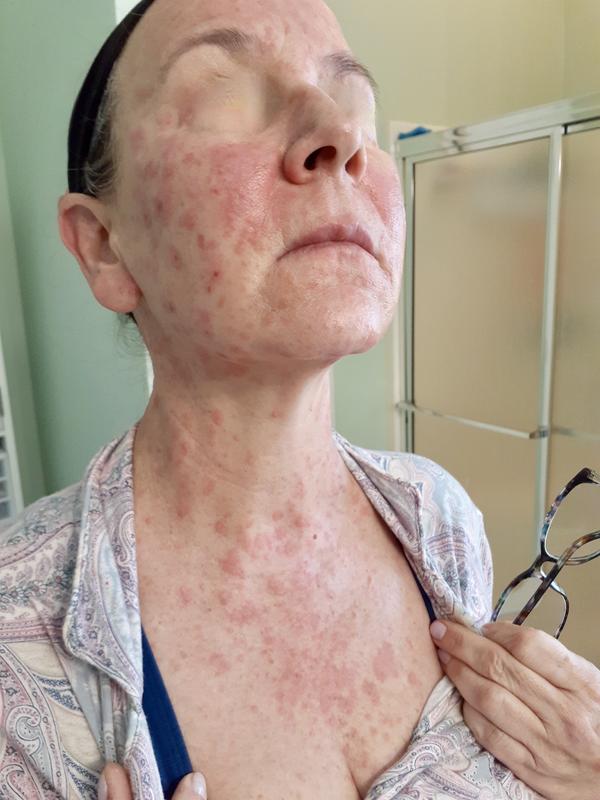 Customer photo for "Allergic reaction"