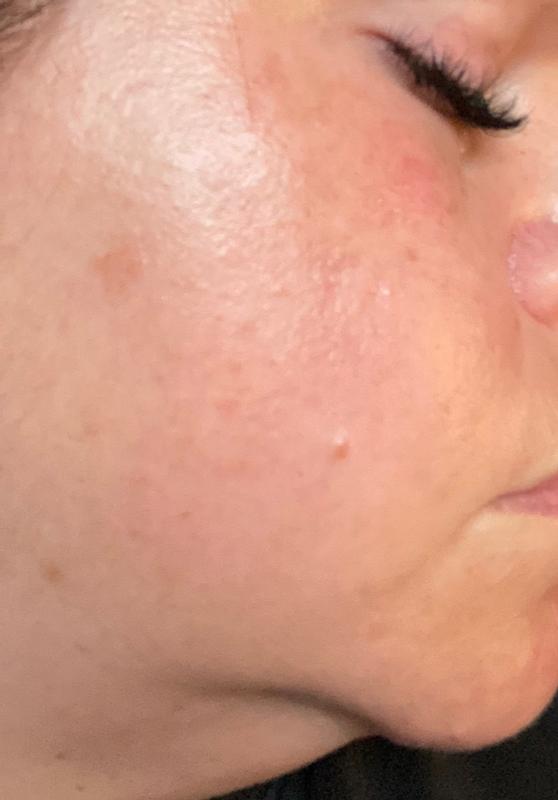 Customer photo for "brighter, glower skin in 6wks (5% now please!!)"