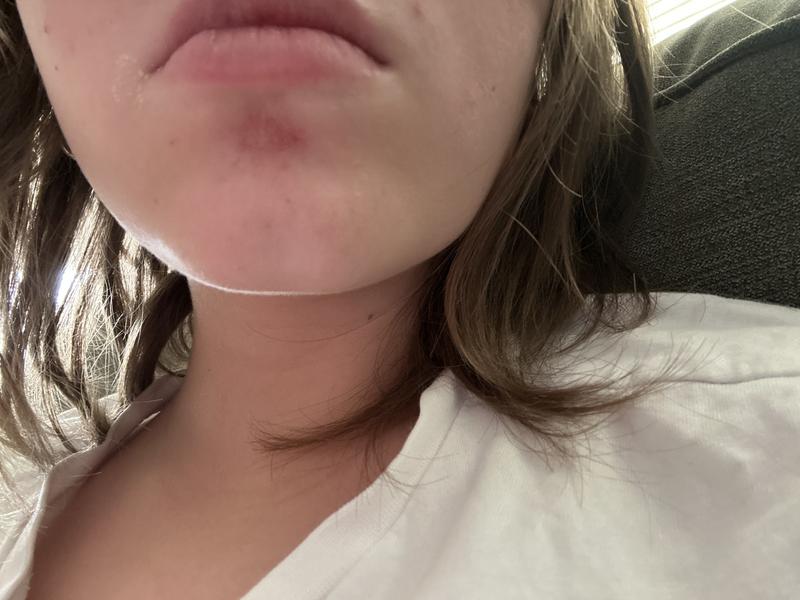 Customer photo for "It burned right below my lower lip"
