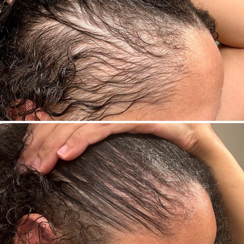 Multi-Peptide Serum for Hair Density