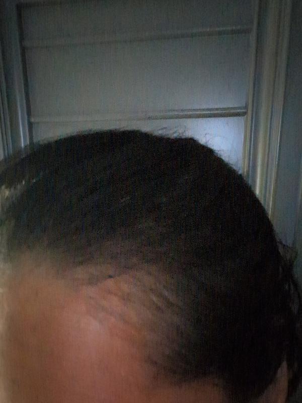 Customer photo for "Massive hair loss and thinning caused by the serum"