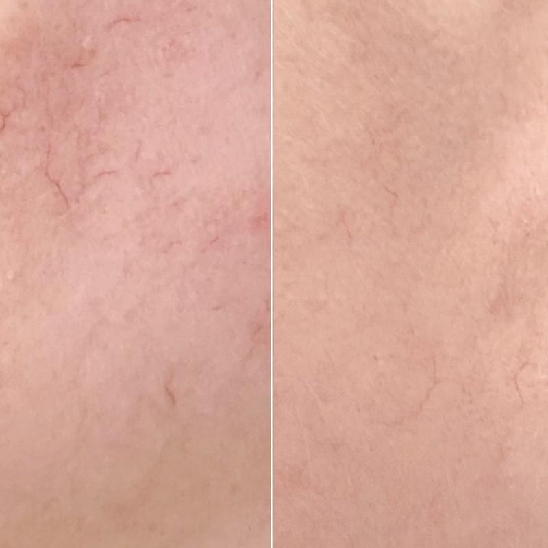 before and after