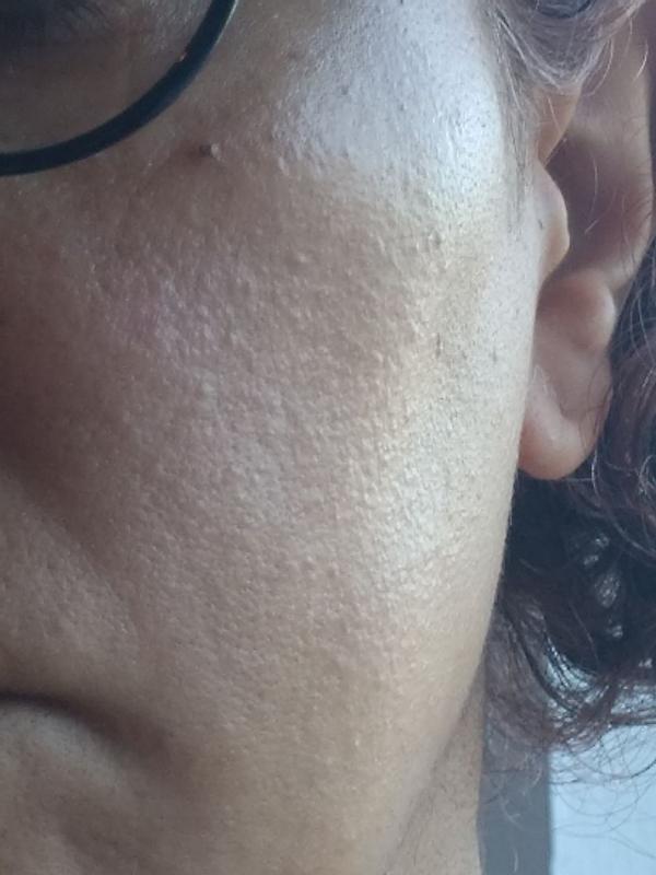 Customer photo for "Caused Breakouts After a few Uses"