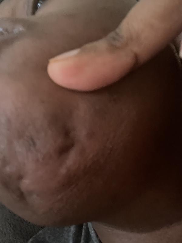 Customer photo for "Breakouts no more"