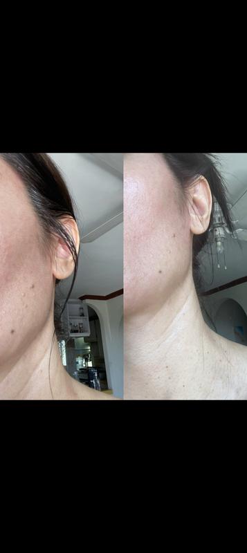 Customer photo for "Game changer for oily/combo skin"