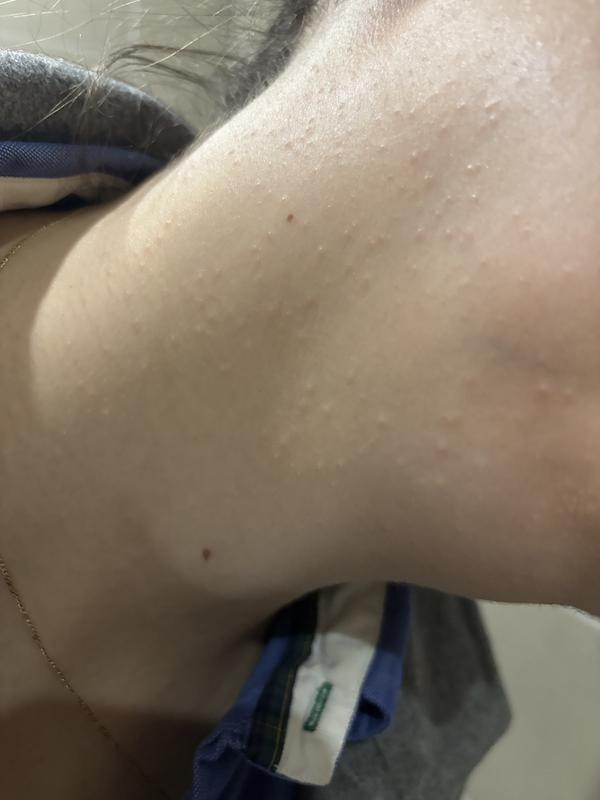 Customer photo for "Bumpy and Sore Skin"