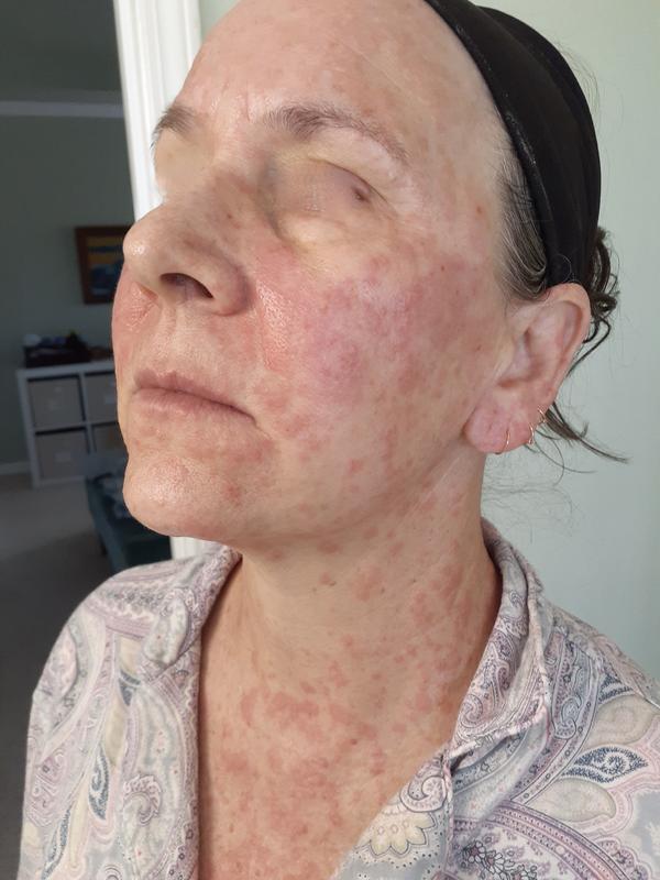 Customer photo for "Allergic reaction"
