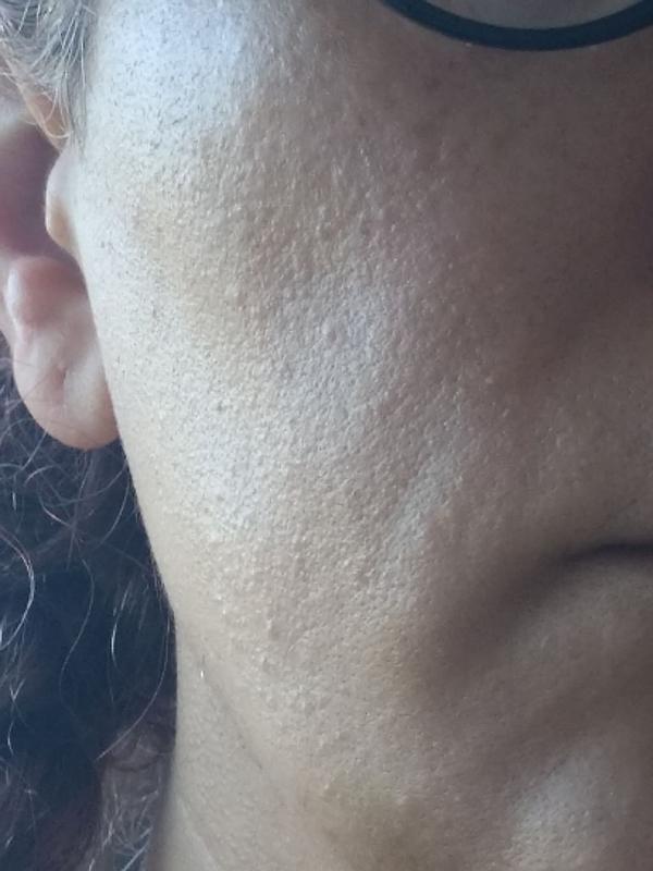 Customer photo for "Caused Breakouts After a few Uses"