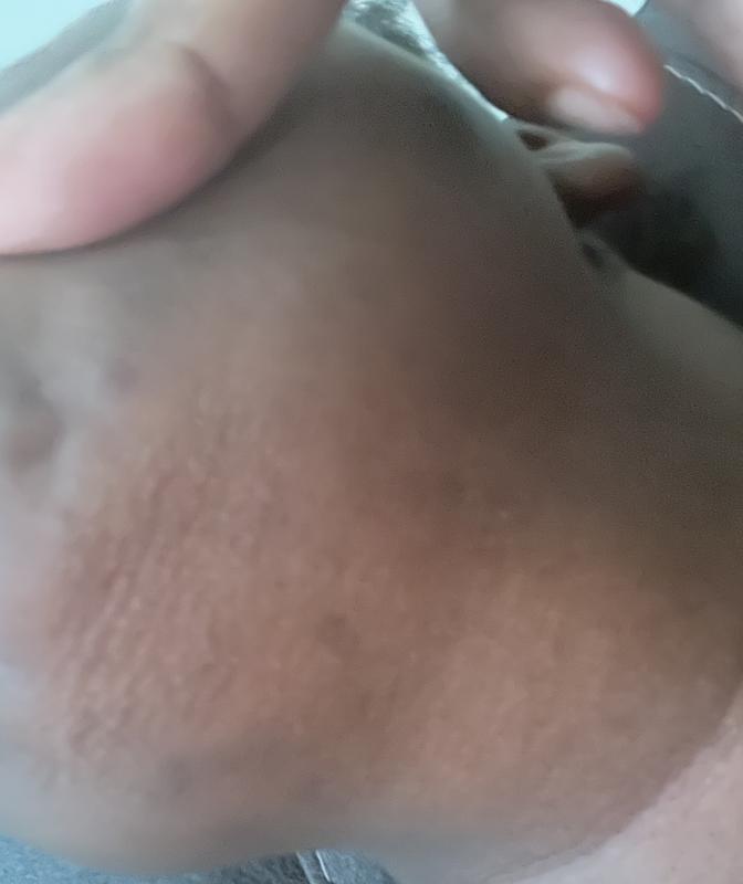Customer photo for "Breakouts no more"