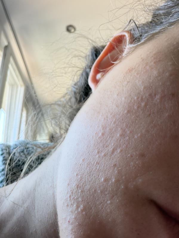 Customer photo for "Severely irritated my skin and caused bumps"
