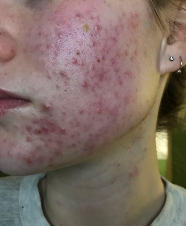 Customer photo for "This product literally saved my skin!"