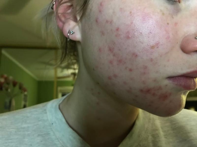 Customer photo for "This product literally saved my skin!"