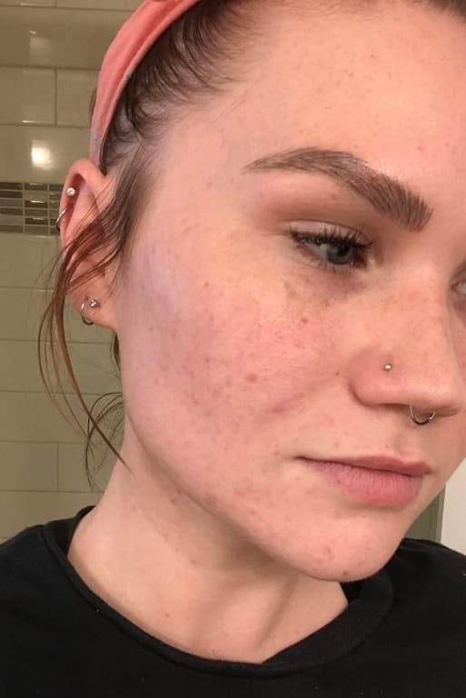Customer photo for "This product literally saved my skin!"