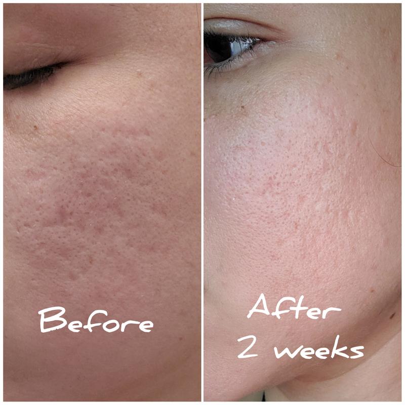 Resurfacing Scar Gel | Acne Scar Treatment | Differin