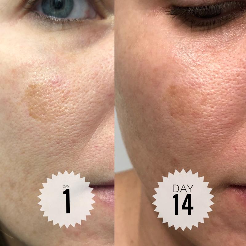 Dark Spot Correcting Serum Differin