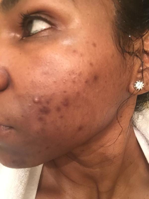 Best Acne treatment in the market
