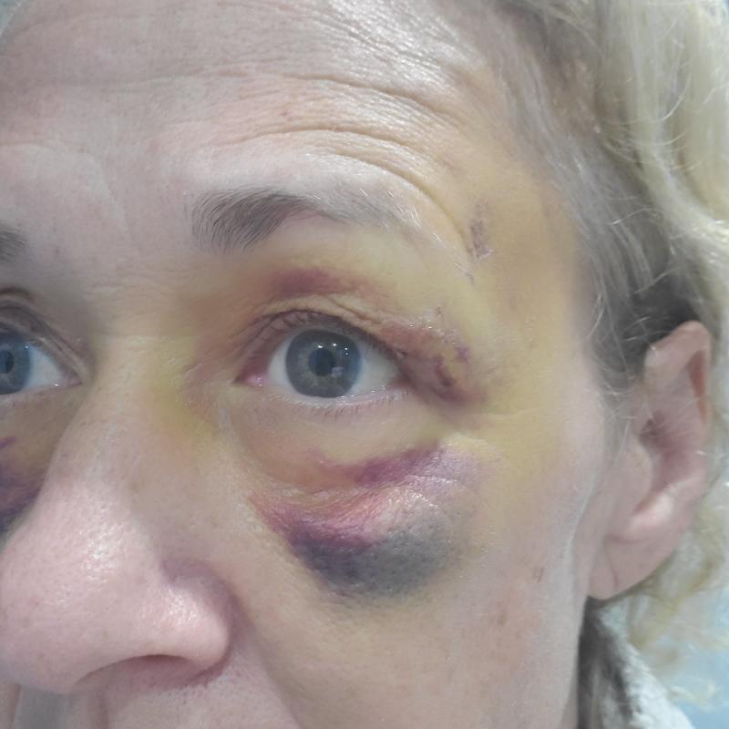 Even helped black eyes!