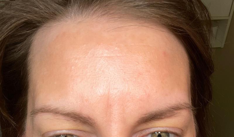Kills light to medium forehead wrinkles