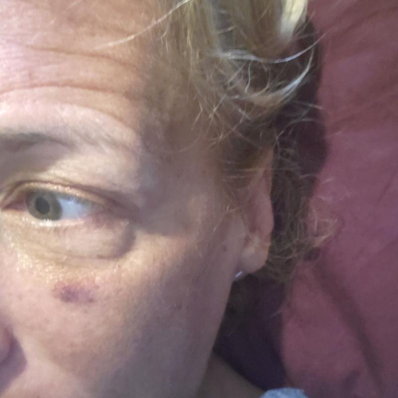 Even helped black eyes!