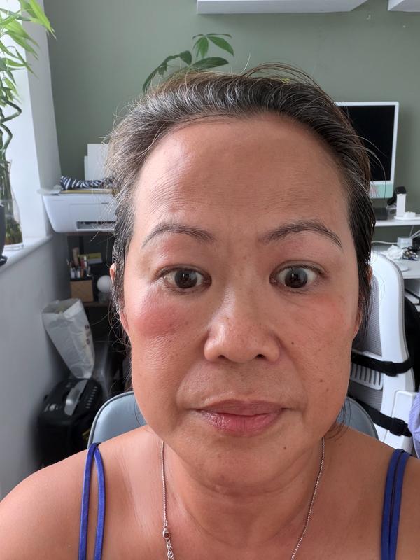 Customer photo for "Puffyness & Redness"
