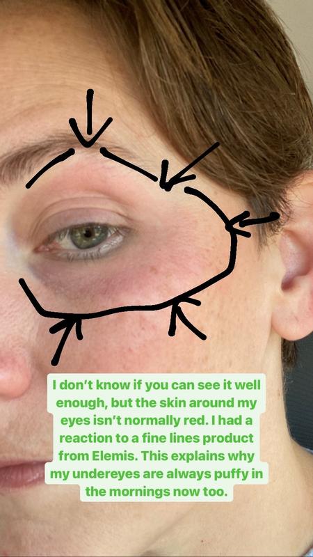 Red and Puffy Allergic Reaction