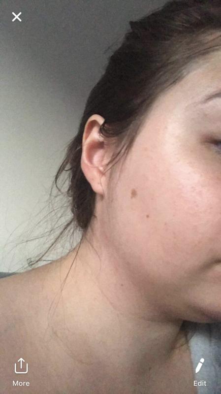 One month after using Papaya Enzyme peel twice a week