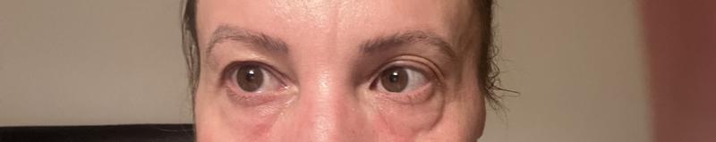 My eyes next morning after applying retinol cream