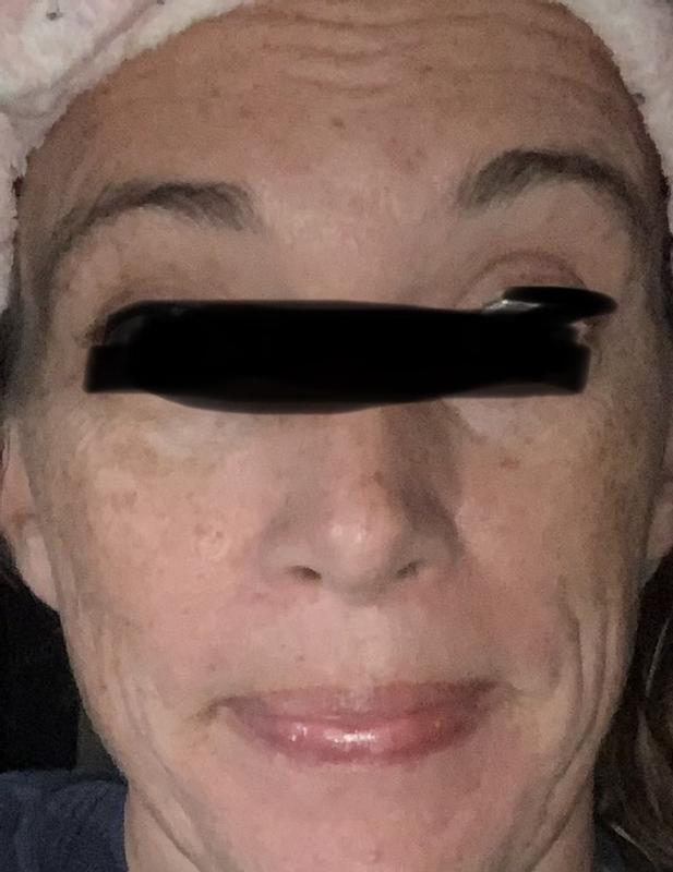 Customer photo for "Skin soft and lines softening around eye brows"