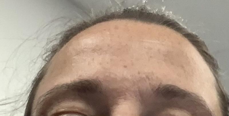 Customer photo for "Skin soft and lines softening around eye brows"